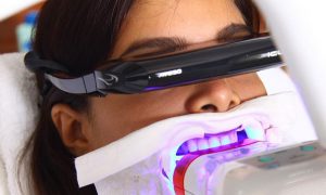 Características del blanqueamiento dental LED